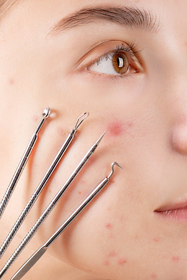 Close-up of skincare tools on acne-affected skin for dermatological treatment.
