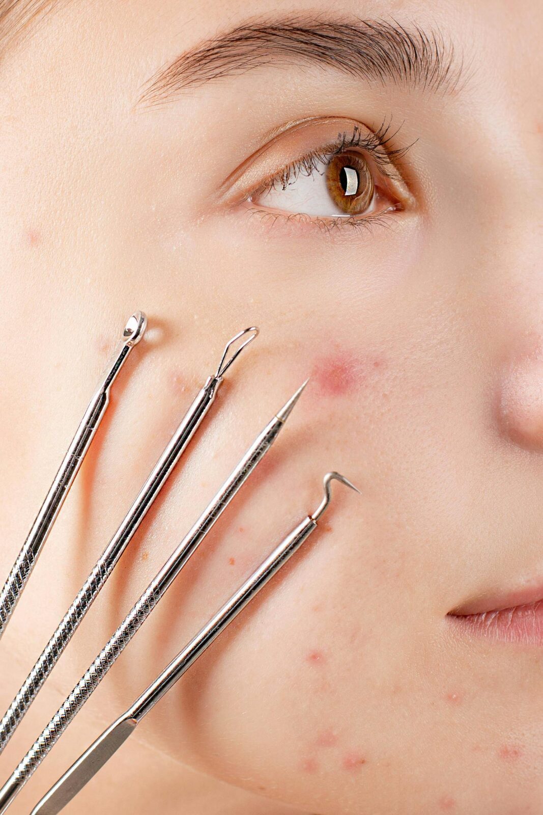 Close-up of skincare tools on acne-affected skin for dermatological treatment.